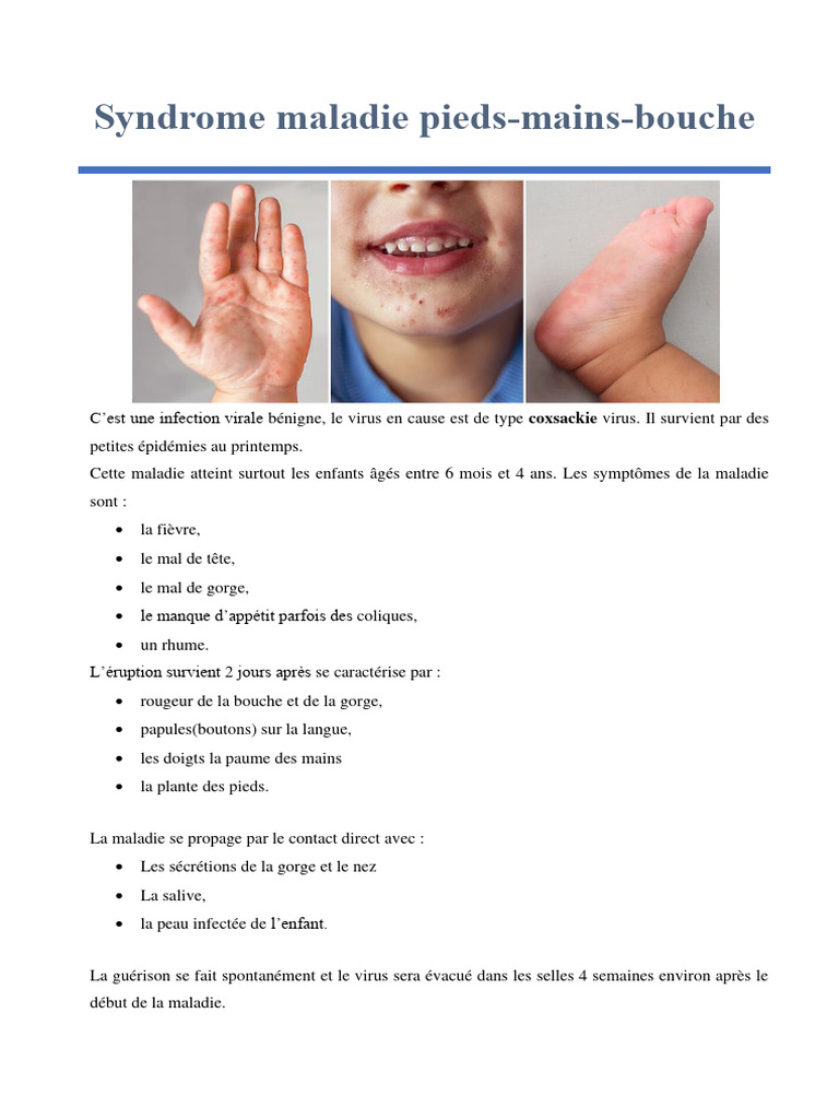Syndrome Pieds mains bouche Chez L enfant PDF Sciences Et Math matiques