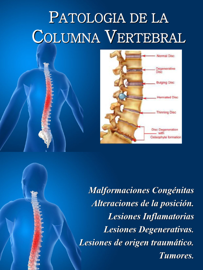 Patología de la Columna Vertebral | PDF | La columna vertebral | Vértebra