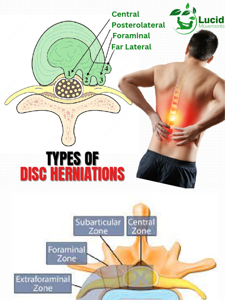 Disc Herniations | PDF | Art