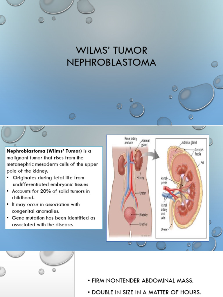 WILMS TUMOR New | PDF | Medical Specialties | Human Diseases And Disorders