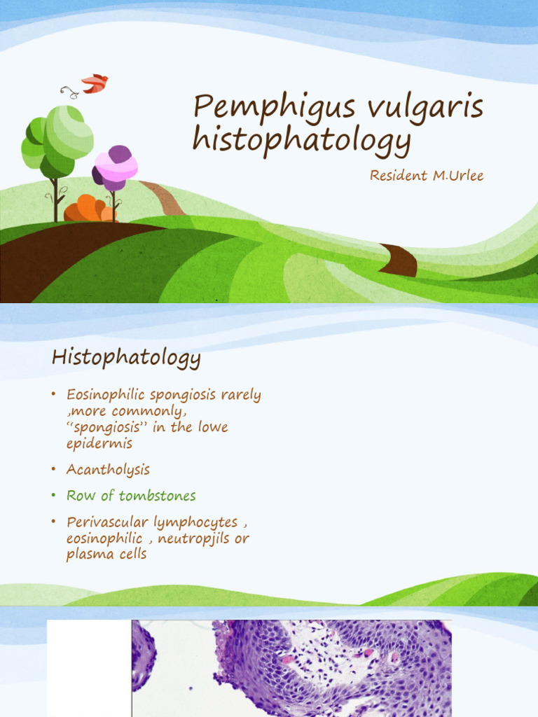 Pemphigus Vulgaris Linear IgA Dermatitis PDF