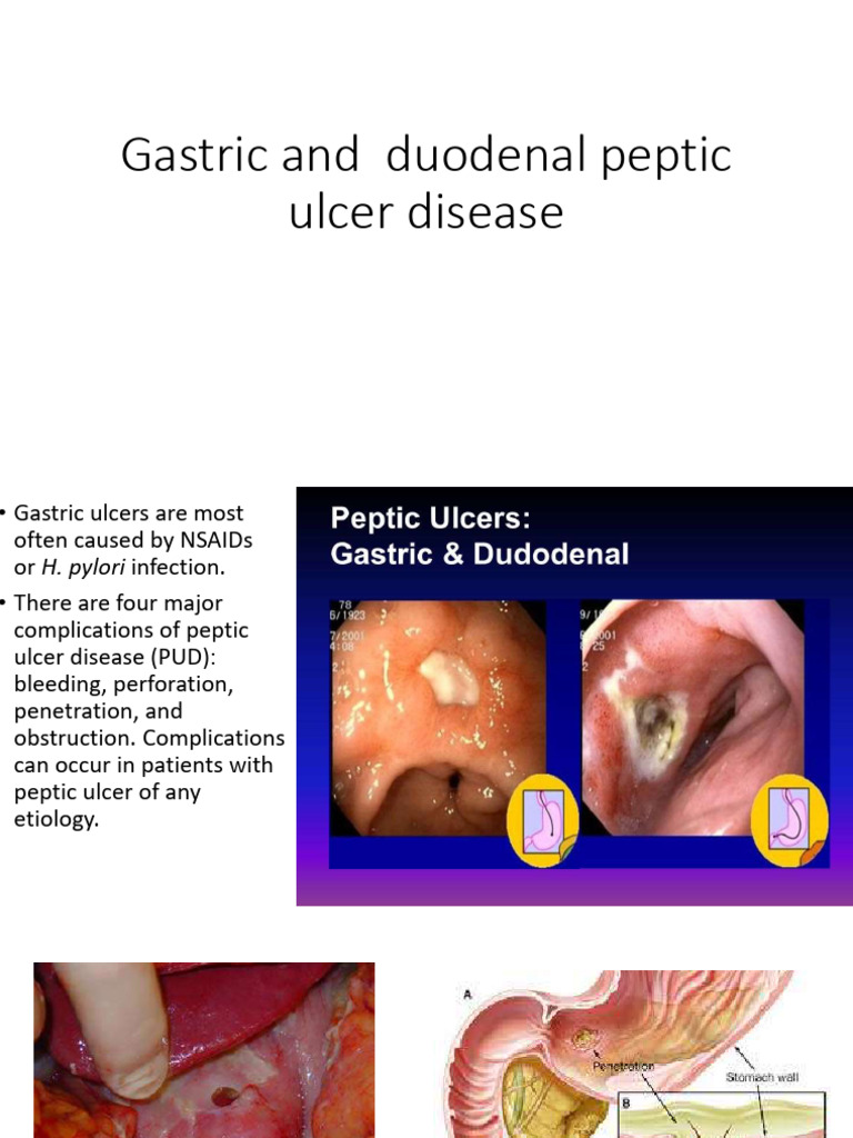 2 Gastric and Duodenal Peptic Ulcer Disease 2 PDF Digestive