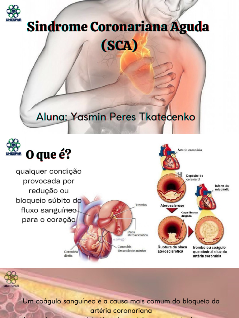 Abordagem da Síndrome Coronariana Aguda | PDF | Infarto do Miocárdio ...