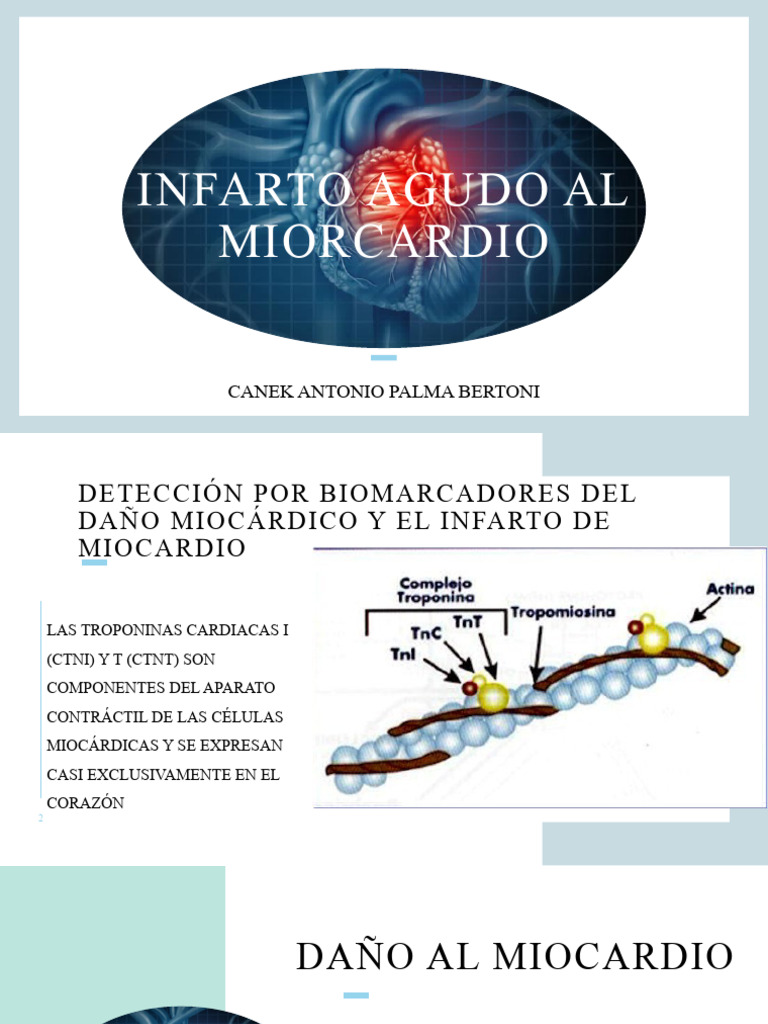 Infato Agudo Al Miocardio | Descargar gratis PDF | Infarto de miocardio ...