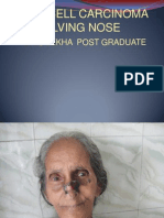 Basal Cell Carcinoma Involving Nose: Dr.S.Lekha Post Graduate