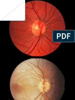 Retinopatia esclerohipertensiva.071105