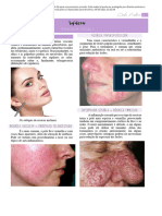 Rosácea Conceito, Tipos, Patogenia, Dermatopatologia, Exame Físico