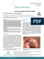 Intratonsillar Abscess