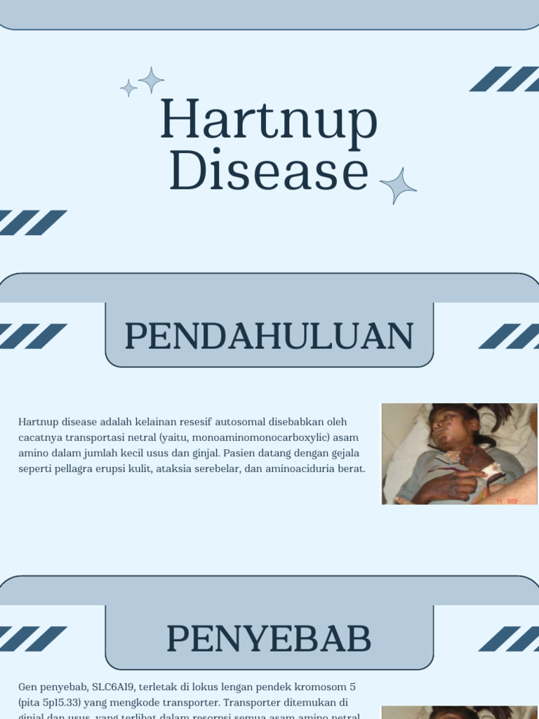 Hartnup Desease | PDF