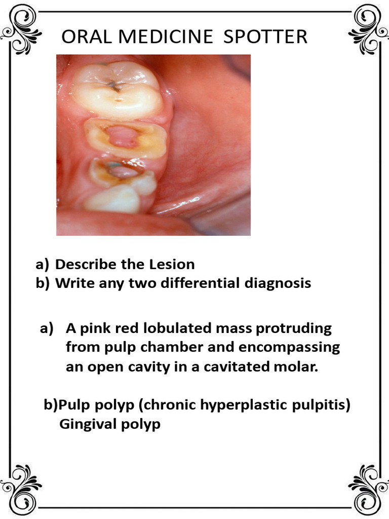 Pulp Polyp and Differential Diagnosis | PDF | Dentistry Branches ...