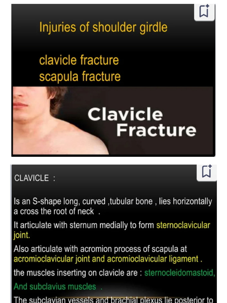 Clavicle fracture | PDF