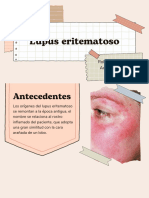 Lupus Eritematoso