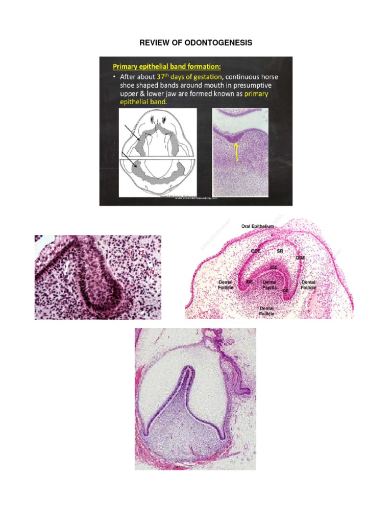 Disproportional Macrodontia Overview | PDF | Human Tooth | Tooth Enamel