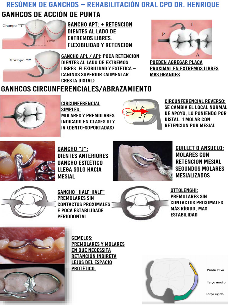 Tipos De Ganchos En Pr tesis Removible PDF