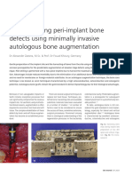 The Bone Core Technique Reconstructing Peri Implant Bone Defects Using Minimally Invasive Autologous Bone Augmentation