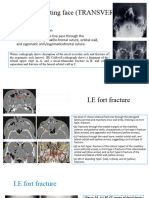 Le Fort Iii/floating Face (TRANSVERSE)