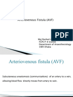 Arteriovenous Fistula (AVF) : Maj Rashed Ashraf FCPS P-II Trainee Department of Anaesthesiology CMH Dhaka