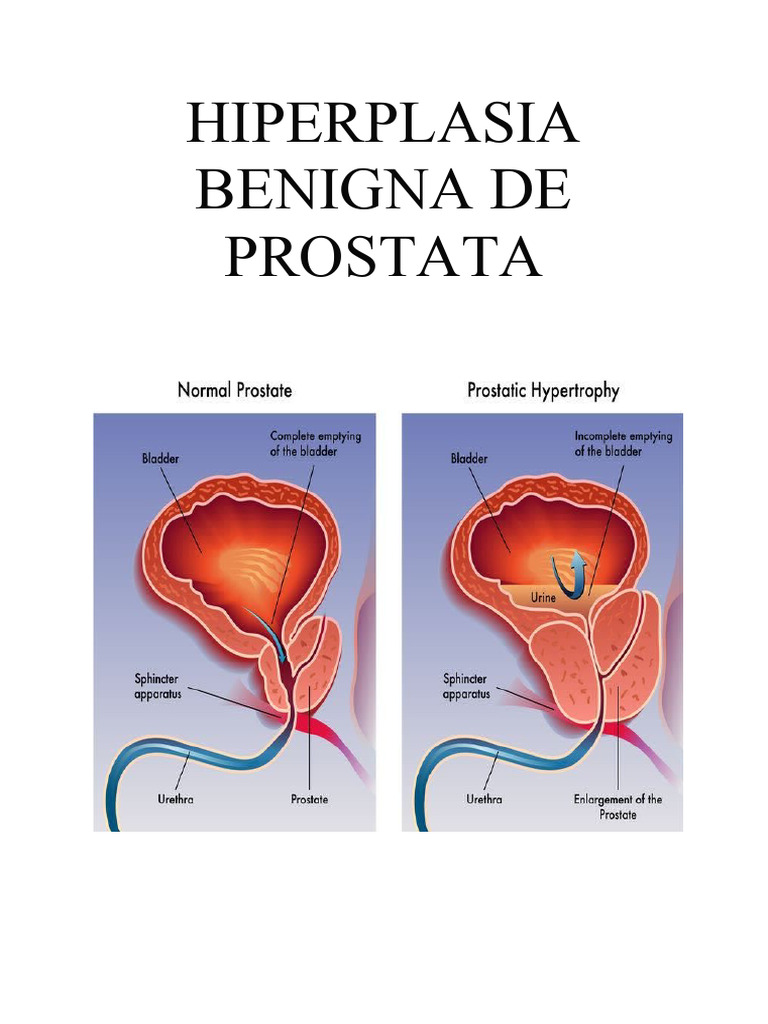 Hiperplasia Benigna de Próstata: Guía Completa | PDF