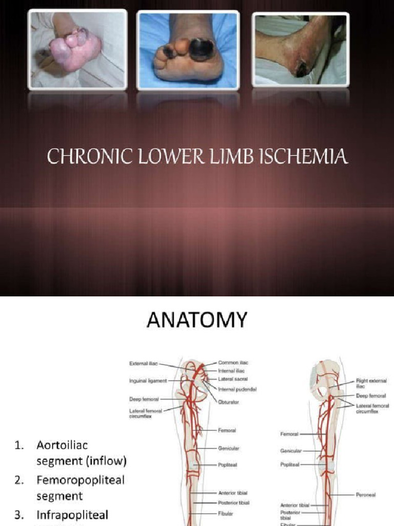 Chronic limb ischemic pdf
