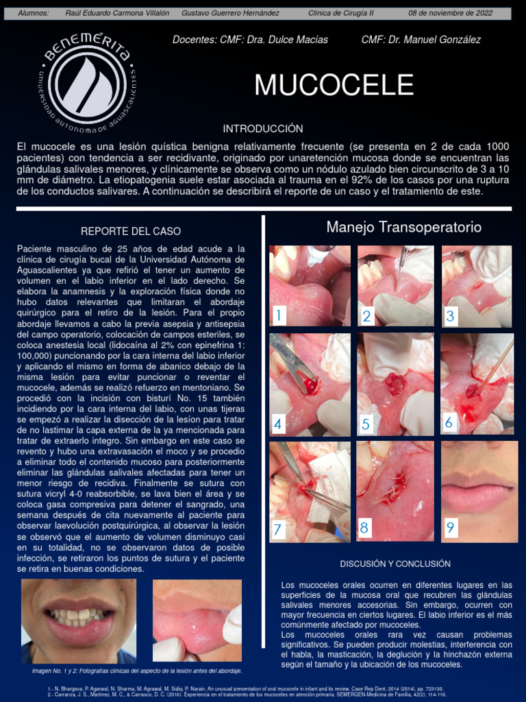 Caso Clinico CX Mucocele PDF