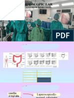 (Low Anterior Resection) : Laparoscopic Lar