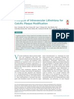 Principles of IVL For Calcific Plaque Modif