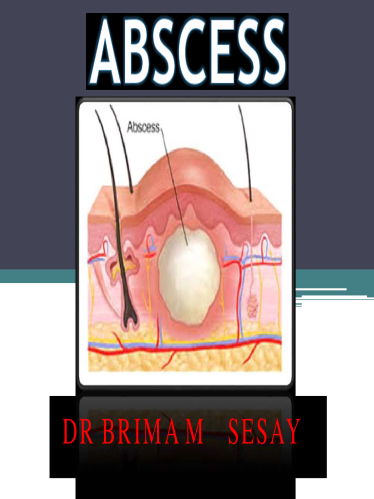 14 Abscess | PDF