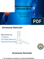 Painfull Accessory Navicular Bone