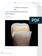 Posterior Indirect Adhesive Restorations - En.es