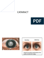 CATARACT