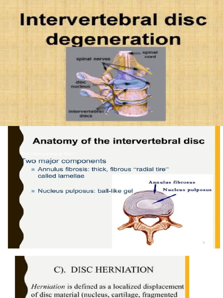 Degenerative Disc Disease PDF