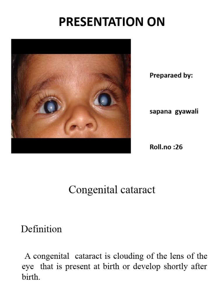 Congenital Cataract | PDF | Cataract | Human Eye