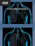 Pneumoultramicroscopicossilicovulcanoconiose: Sintomas e Tratamento | PDF