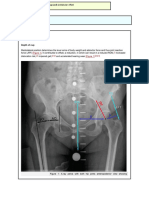 Depth of Cup and Acetabular Offset