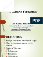 Utrine Fibroid