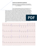 Casos Clinicos de Cardiopatias Isquemicas