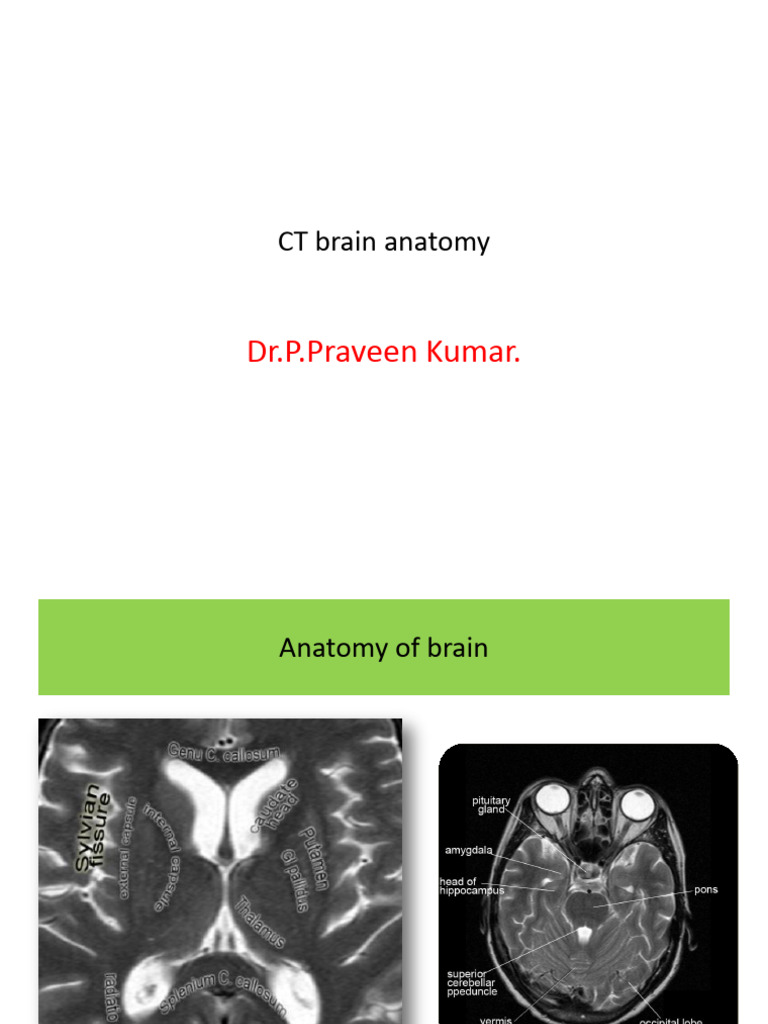 CT Sinus Brain Lab Protocol Overview | PDF | Spinal Cord | Thrombosis