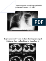 Pleural Empyema TMK