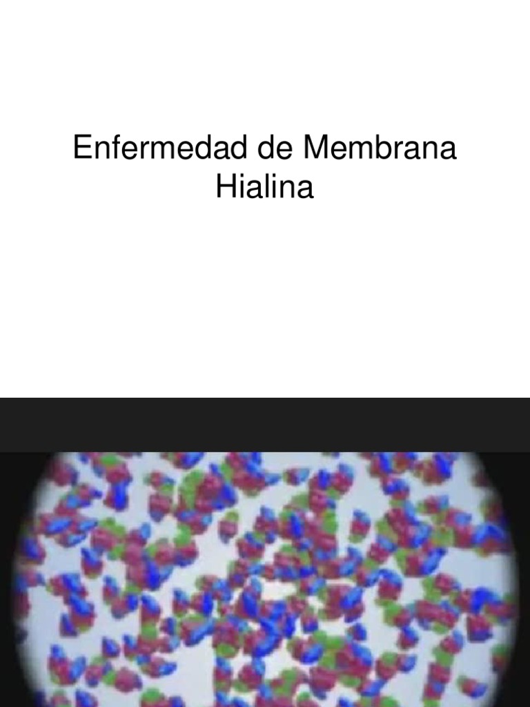 Enfermedad de Membrana Hialina PDF Pulmón Lípido