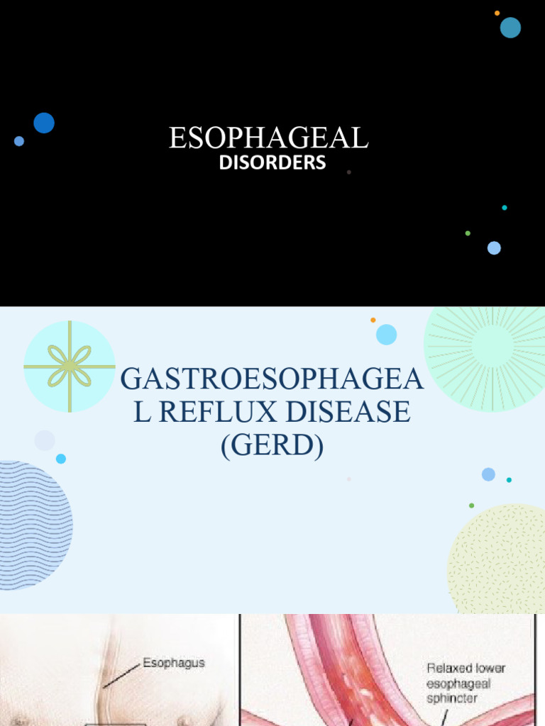 Gastroesophageal Reflux Disease Gerd 1 | Download Free PDF ...