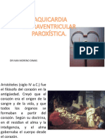 Taquicardia Supraventricular Paroxística