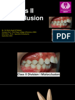 Class II Malocclusion