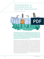 Sofortimplantation in Extraktionsalveole Mit Adaptiertem Implantatsystem