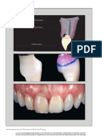 2. Contour Management of Implant Restorations for Optimal Emergence Profiles- Guidelines for Immediate and Delayed Provisional Restorations