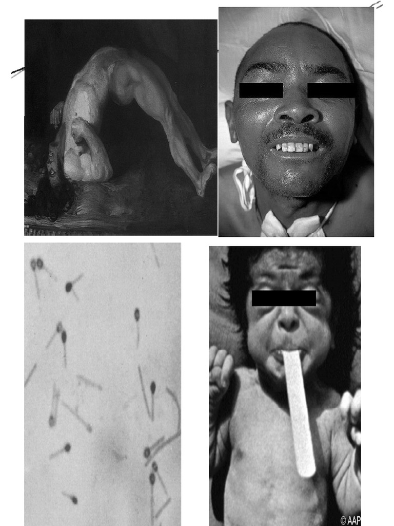 tetanus-pdf-medicine-public-health