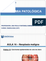 Aula 16 Praticas 10 Carcinoma Epidermóide Do Colo Do Útero