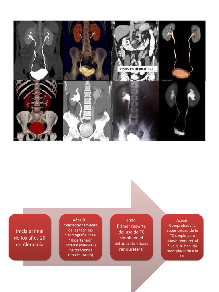Evolución de la TC en litiasis renal | PDF | Riñón | Sistema urinario