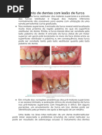 Classificação e Tratamento de Lesões de Furca | PDF | Odontologia ...