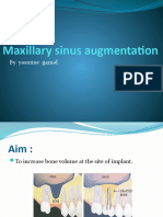 Maxillary Sinus Augmentation