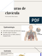 Fracturas de Clavicula